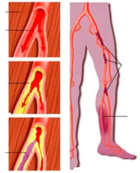 Atherosclerosis of the lower extremities