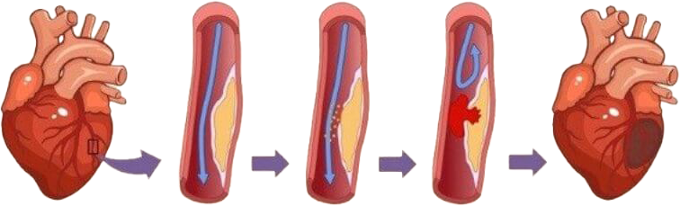 Evoultion of myocardial infarction