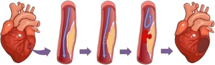 Evoultion of myocardial infarction