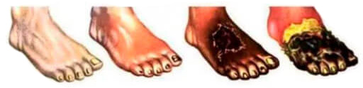 Steps of gangrene progress