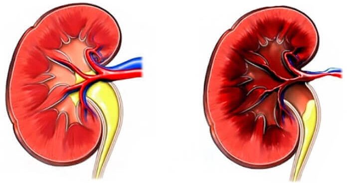 Renal hypertension