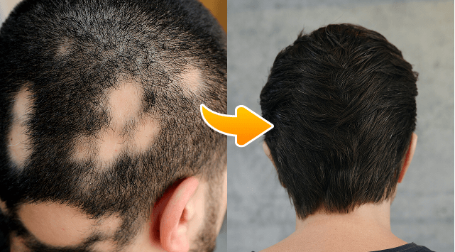 photo before and after treatment