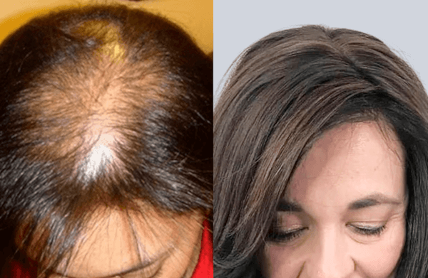 photo before and after treatment