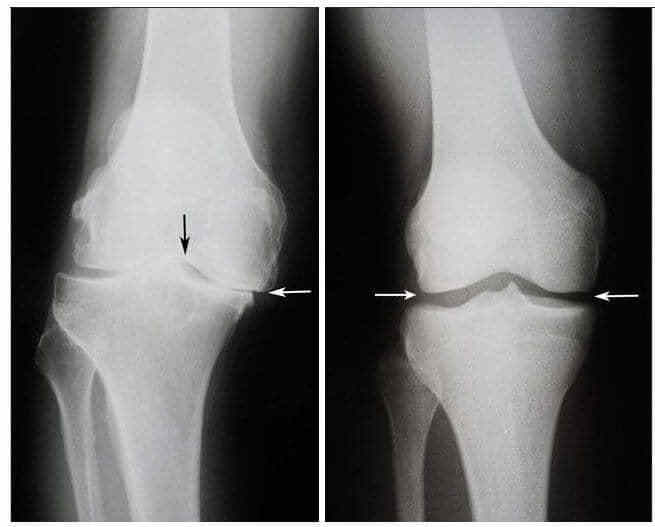 Знімок колінного суглоба Валентини до і після лікування