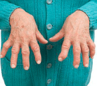 Հոդային հիվանդությունները բերում են տեղային կաթվածի և հաշմանդամության