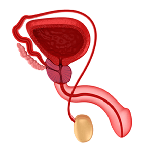 პროსტატიტის მაგალითი